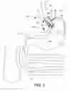 Fig. 04 - System and apparatus for adjustable gastric bypass