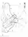Fig. 06 - System and apparatus for adjustable gastric bypass