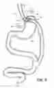 Fig. 11 - System and apparatus for adjustable gastric bypass