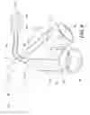 Fig. 13 - System and apparatus for adjustable gastric bypass