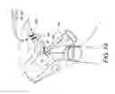 Fig. 15 - System and apparatus for adjustable gastric bypass