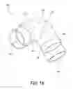 Fig. 18 - System and apparatus for adjustable gastric bypass