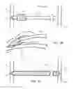 Fig. 03 - EXTERNAL SUPPORT FOR ELONGATED BODILY VESSELS