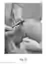 Fig. 30 - Apparatus and method for clamping and trimming the bone tendon portion of a graft to a desired size