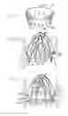 Fig. 08 - Heart valve annulus device and method of using same