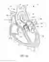 Fig. 03 - PROSTHETIC IMPLANT DELIVERY DEVICE