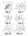 Fig. 04 - Sensors for prosthetic heart devices