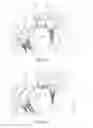 Fig. 09 - Cardiac valve commissure brace