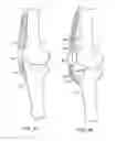 Fig. 03 - Methods of redistributing forces for the patella with spacers