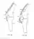 Fig. 04 - Methods of redistributing forces for the patella with spacers
