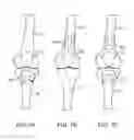 Fig. 06 - Methods of redistributing forces for the patella with spacers