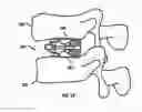 Fig. 10 - Expandable fusion device and method of installation thereof
