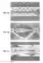 Fig. 10 - LOCKING POLYMER STENTS