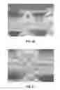 Fig. 12 - LOCKING POLYMER STENTS