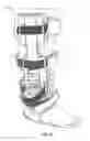 Fig. 14 - Ankle brace