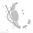 Fig. 65 - Implants with controlled drug delivery features and methods of using same