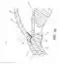 Fig. 71 - Implants with controlled drug delivery features and methods of using same