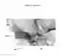 Fig. 22 - Combined laser and phacoemulsification system for eye surgery