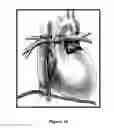 Fig. 35 - Methods of improving myocardial performance in fontan patients using udenafil compositions