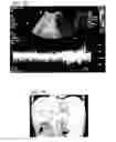 Fig. 03 - Bioengineered allogeneic blood vessel