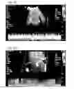 Fig. 12 - Bioengineered allogeneic blood vessel
