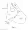 Fig. 02 - Anatomic fit of a percutaneous VAD for right heart support