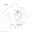 Fig. 10 - Left ventricular cardiac assist pump and methods therefor