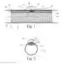 Fig. 02 - Implanted Extracardiac Device for Circulatory Assistance