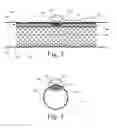 Fig. 03 - Implanted Extracardiac Device for Circulatory Assistance