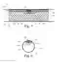 Fig. 04 - Implanted Extracardiac Device for Circulatory Assistance