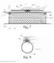 Fig. 05 - Implanted Extracardiac Device for Circulatory Assistance
