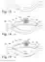 Fig. 08 - Implanted Extracardiac Device for Circulatory Assistance
