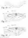 Fig. 09 - Implanted Extracardiac Device for Circulatory Assistance