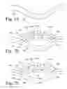 Fig. 10 - Implanted Extracardiac Device for Circulatory Assistance