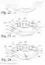 Fig. 11 - Implanted Extracardiac Device for Circulatory Assistance