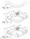 Fig. 15 - Implanted Extracardiac Device for Circulatory Assistance