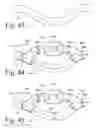 Fig. 18 - Implanted Extracardiac Device for Circulatory Assistance
