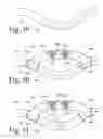 Fig. 20 - Implanted Extracardiac Device for Circulatory Assistance
