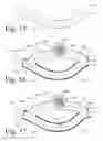 Fig. 22 - Implanted Extracardiac Device for Circulatory Assistance