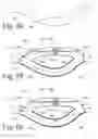 Fig. 23 - Implanted Extracardiac Device for Circulatory Assistance