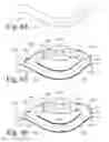 Fig. 25 - Implanted Extracardiac Device for Circulatory Assistance