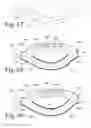 Fig. 26 - Implanted Extracardiac Device for Circulatory Assistance