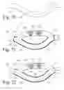 Fig. 27 - Implanted Extracardiac Device for Circulatory Assistance