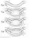 Fig. 29 - Implanted Extracardiac Device for Circulatory Assistance