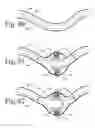 Fig. 30 - Implanted Extracardiac Device for Circulatory Assistance