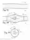 Fig. 31 - Implanted Extracardiac Device for Circulatory Assistance