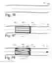 Fig. 35 - Implanted Extracardiac Device for Circulatory Assistance