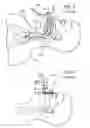 Fig. 04 - Methods, systems and devices for non-invasive open ventilation with gas delivery nozzles with an outer tube