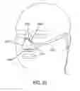 Fig. 22 - Methods, systems and devices for non-invasive open ventilation with gas delivery nozzles with an outer tube