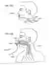 Fig. 70 - Methods, systems and devices for non-invasive open ventilation with gas delivery nozzles with an outer tube